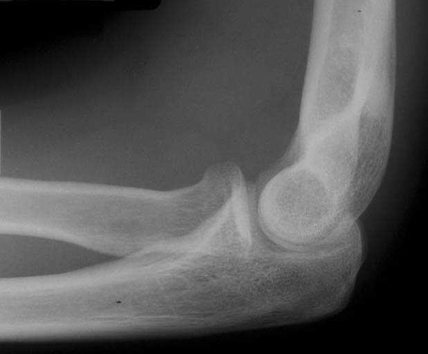 상완골 외상과염