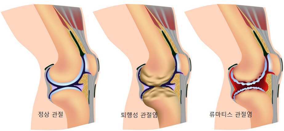 슬개골 연골 연화증