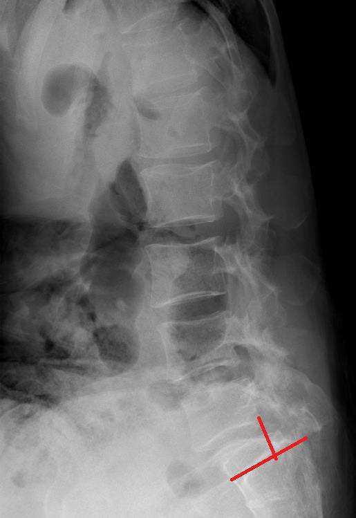 척추전방전위증