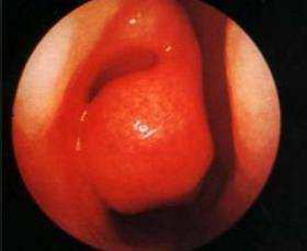 알레르기성 비염