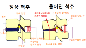 hnp - low back pain