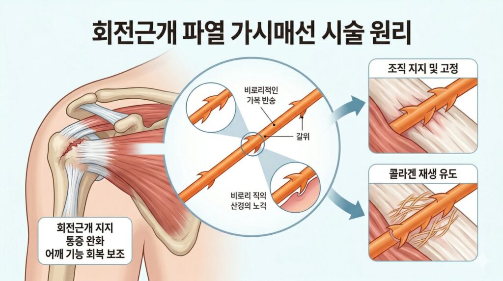 소생한의원 회전근개 가시매선 요법 