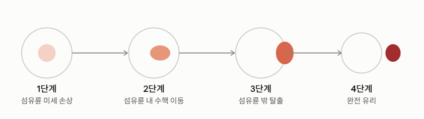 허리 디스크의 단계