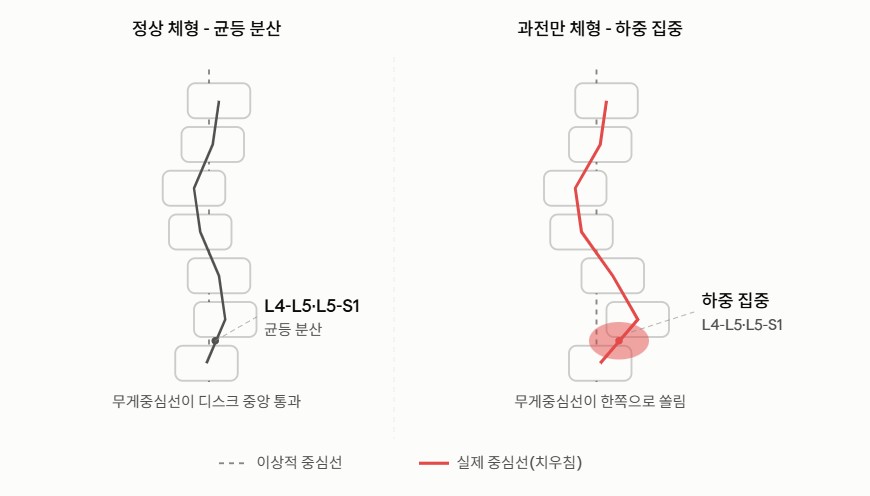 인체 중심 중력선과 허리 디스크