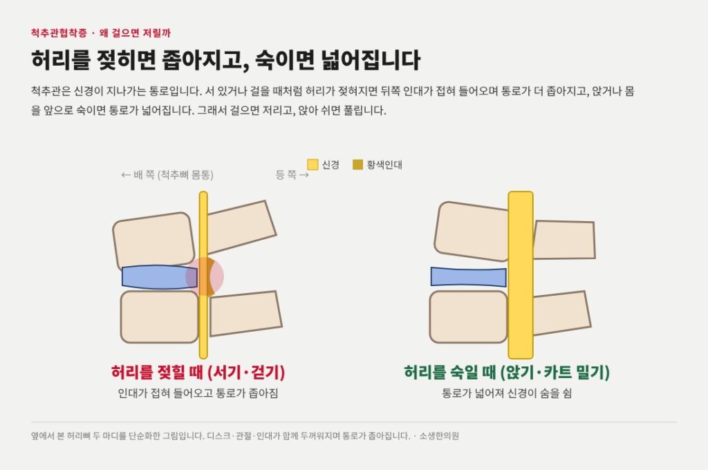척추관협착증