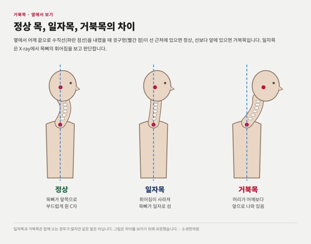 두통 어지러움증 상부경추교정