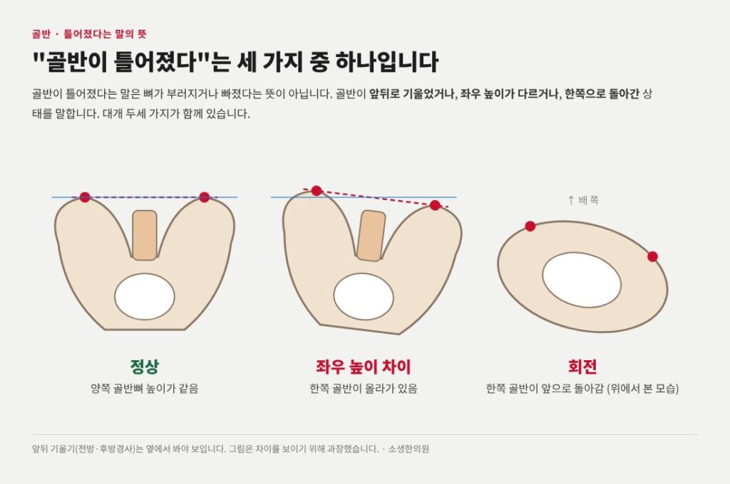 골반틀어짐, 골반교정