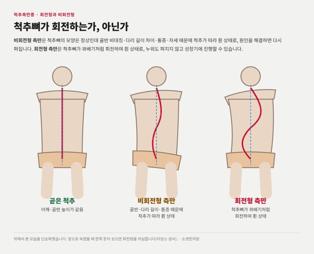 척추측만증 유형