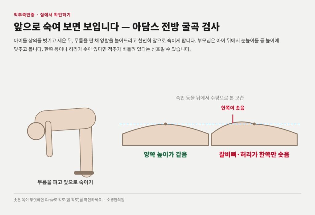 척추측만증 아담스검사