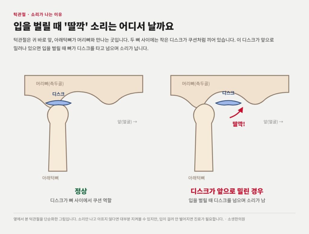 턱관절 장애