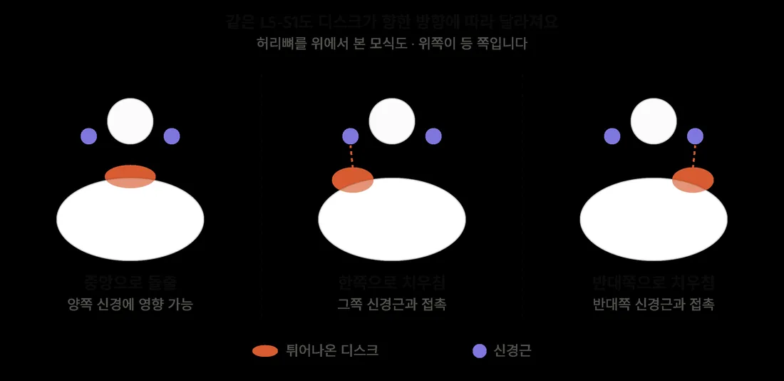 디스크가 중앙, 한쪽, 반대쪽으로 튀어나올 때 닿는 신경근 비교