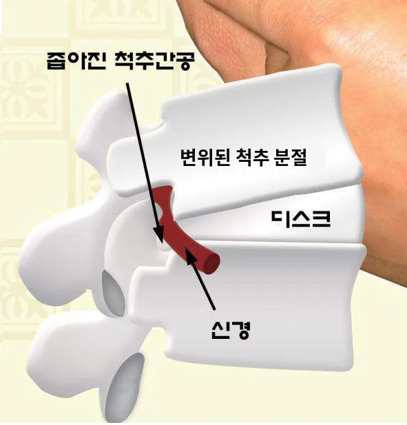 척추뼈가 어긋나며 신경이 나가는 구멍(척추간공)이 좁아진 모습