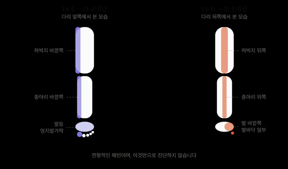 L5 신경근과 S1 신경근이 저리게 하는 다리 부위 비교