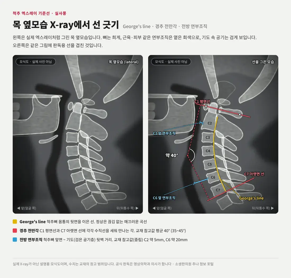 실제 엑스레이처럼 그린 목 옆모습 모식도와, 같은 그림에 George's line, C1 평면선·C7 아랫면 선으로 잰 경추 전만각, C2·C6 앞 연부조직 두께를 표시한 그림