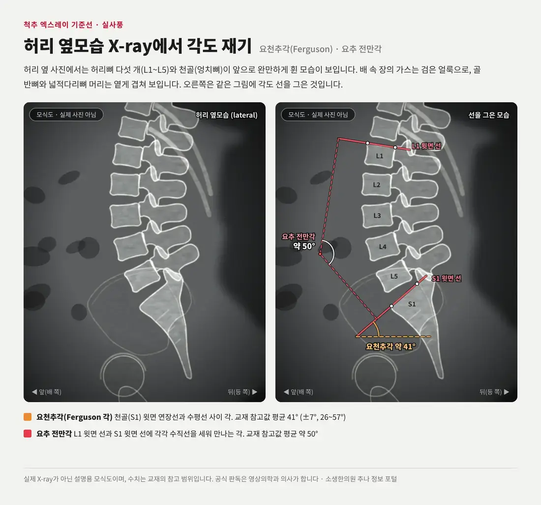실제 엑스레이처럼 그린 허리 옆모습 모식도와, 같은 그림에 천골 윗면과 수평선의 요천추각(Ferguson 각), L1·S1 윗면 선으로 잰 요추 전만각을 표시한 그림