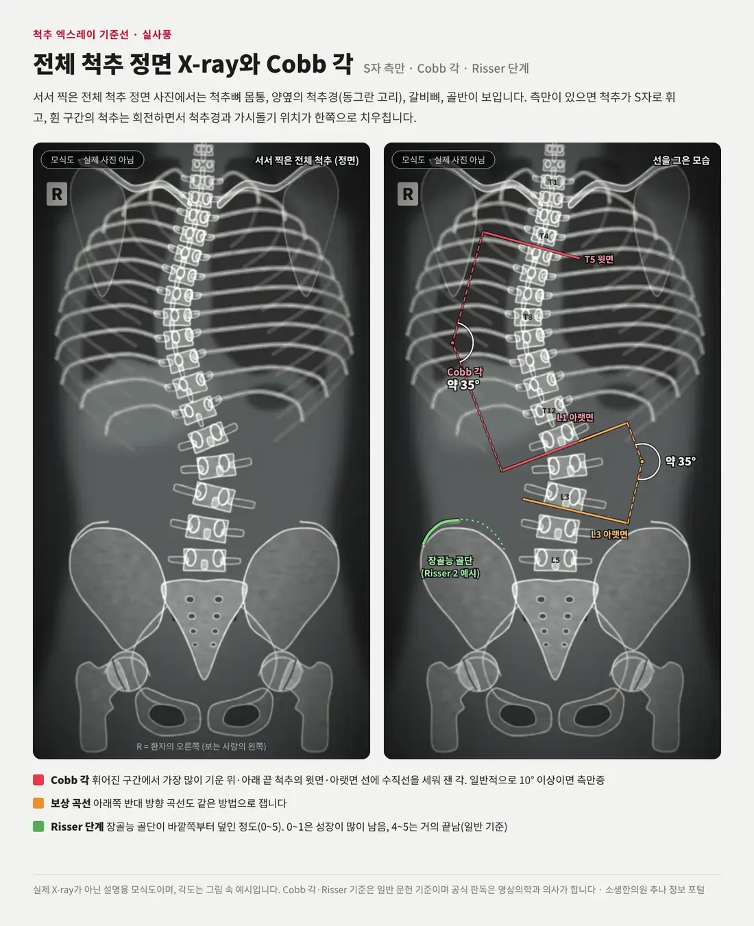 옆으로 휘어진 척추를 정면에서 본 X-ray 모식도로, 휜 구간 양 끝 척추의 기울기와 골반 장골능을 표시한 그림