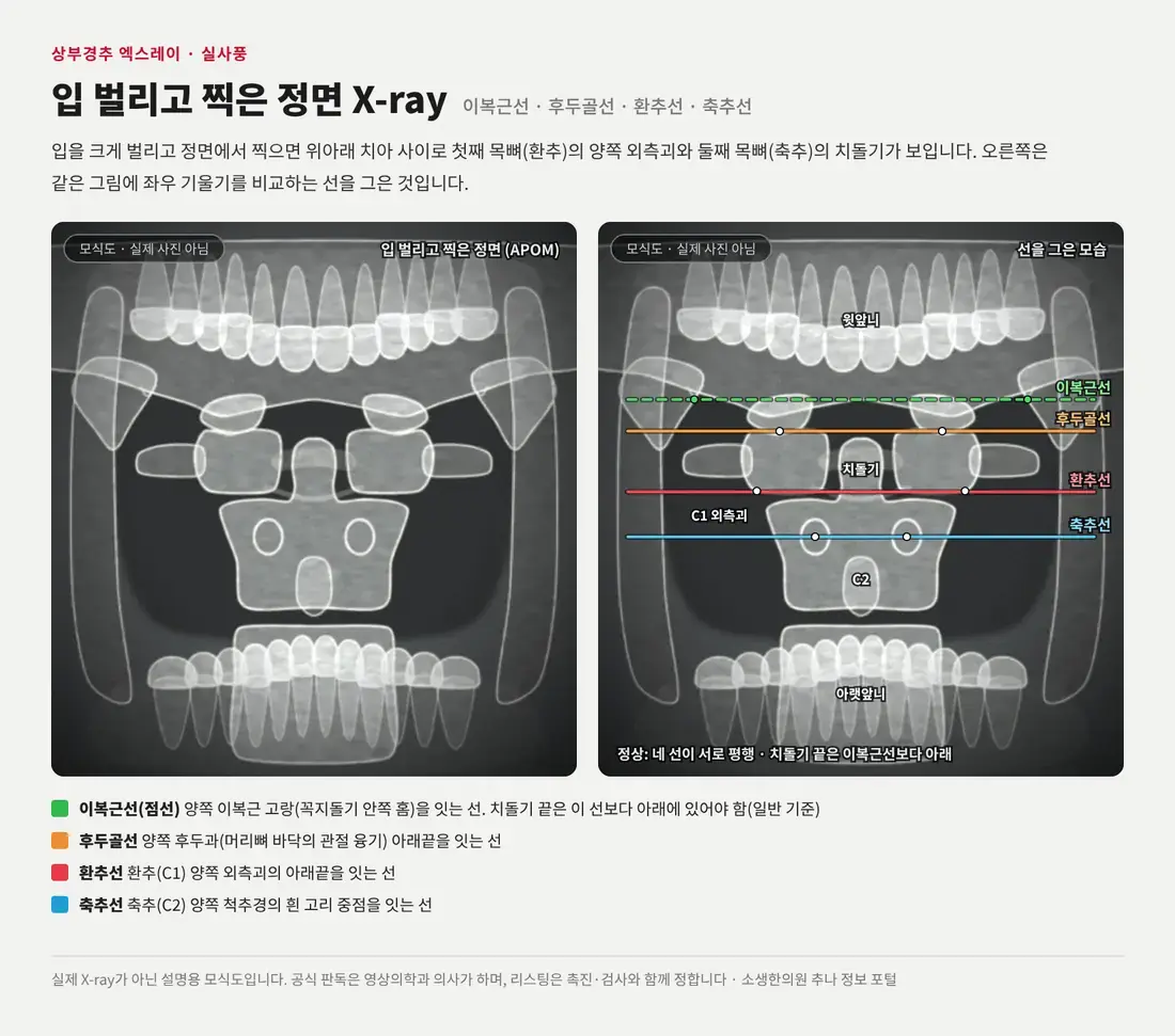 실제 엑스레이처럼 그린 입 벌리고 찍은 정면 모식도에서 치아 사이로 보이는 환추 외측괴·치돌기·축추와 이복근선, 후두골선, 환추선, 축추선을 표시한 그림