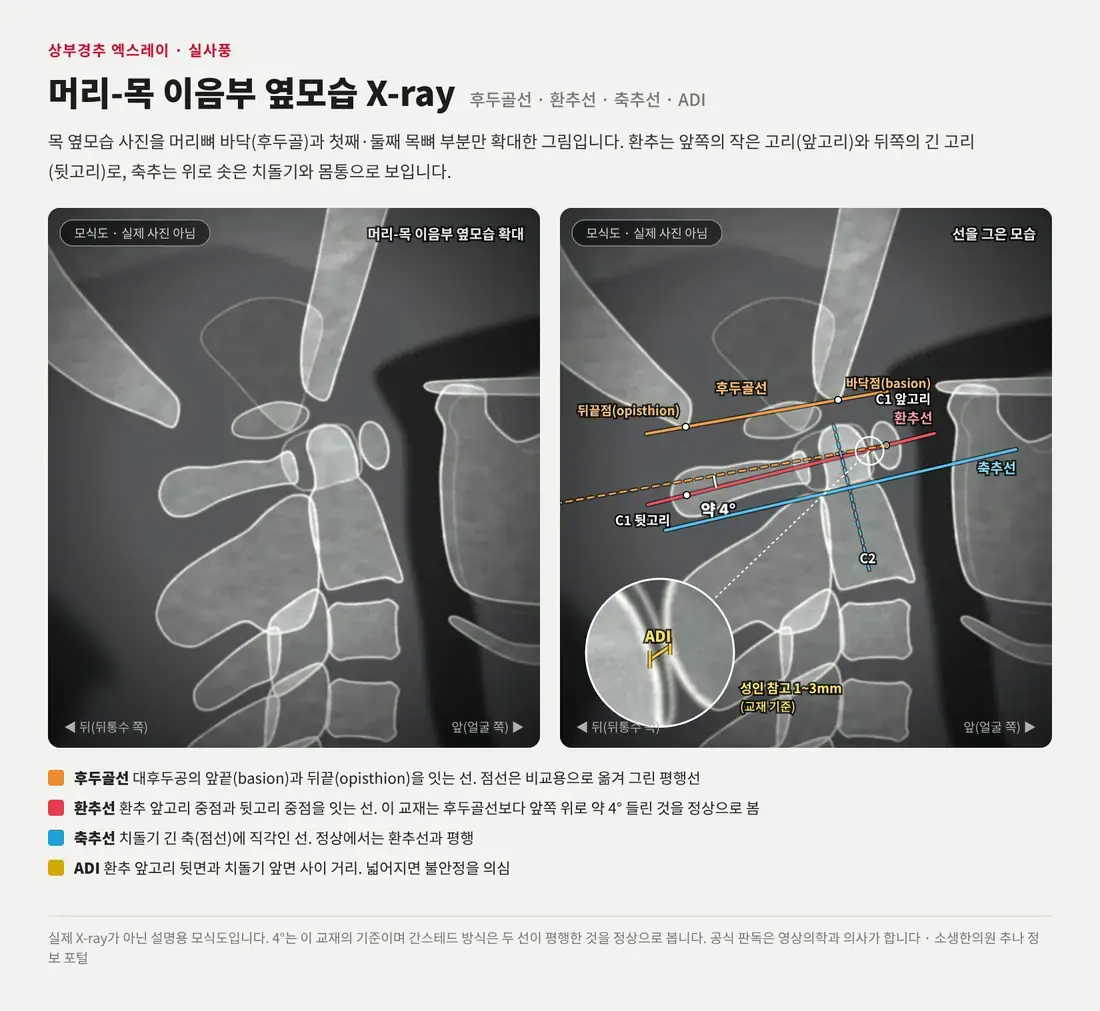 실제 엑스레이처럼 그린 머리-목 이음부 옆모습 모식도에 후두골선, 약 4° 들린 환추선, 축추선과 ADI 확대 그림을 표시한 그림