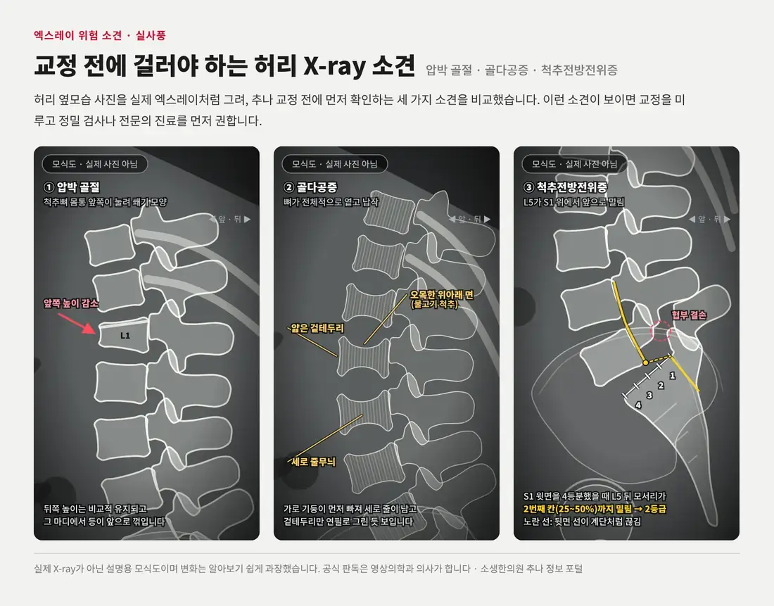 실제 엑스레이처럼 그린 허리 옆모습 모식도 세 장: 앞쪽이 눌린 쐐기 모양 압박 골절, 얇은 겉테두리와 세로 줄무늬·물고기 척추가 보이는 골다공증, L5가 S1 위에서 앞으로 밀린 2등급 척추전방전위증
