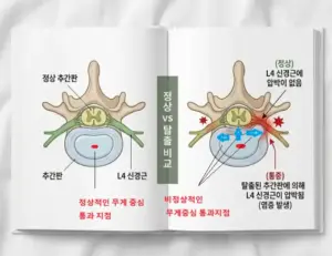 허리디스크 횡단면