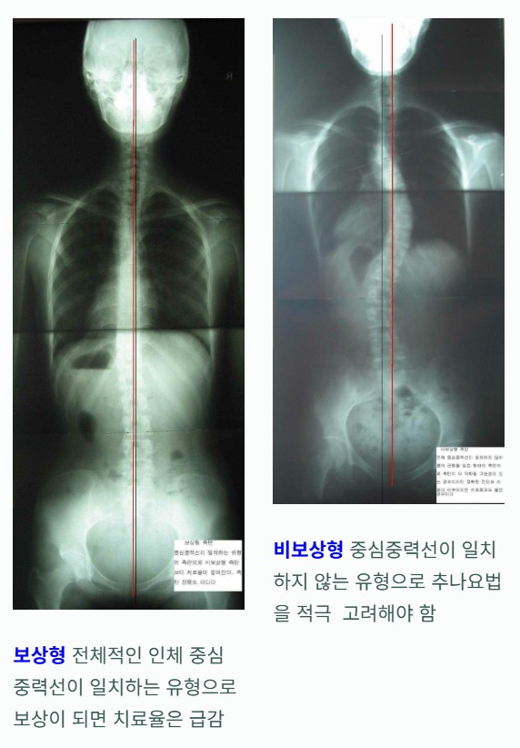 척추측만증 분류