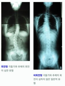 척추측만증 분류
