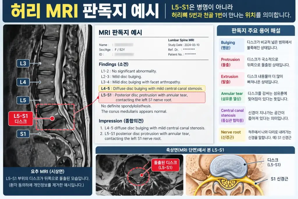 허리 MRI 판독지 예시와 용어 해설